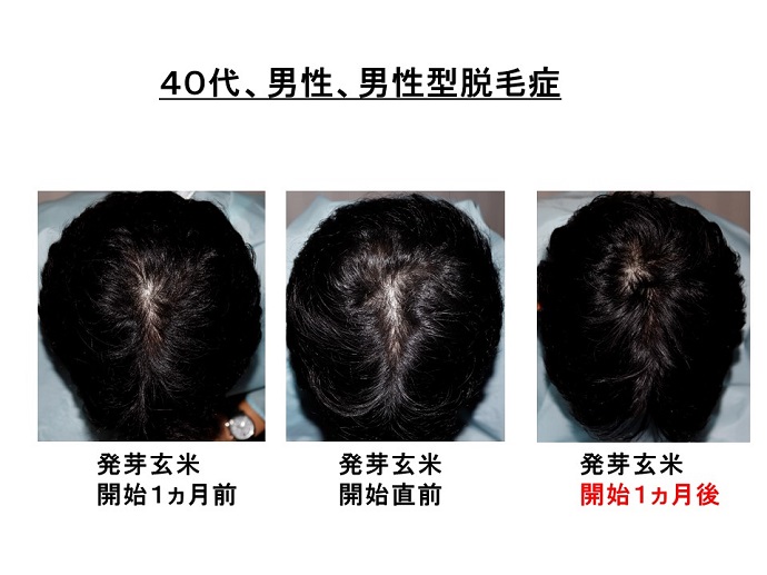 円形脱毛症　病院